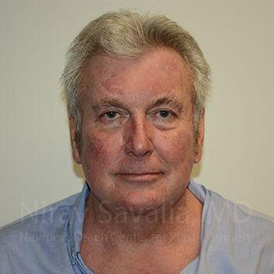 Facelift Before & After Gallery - Patient 1655717 - After