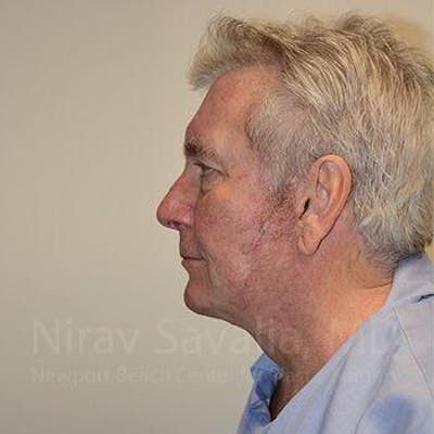 Fat Grafting to Face Before & After Gallery - Patient 1655717 - After