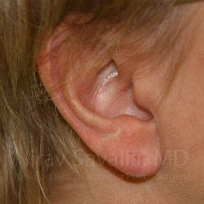 Torn Earlobe Repair Ear Gauge Repair Before & After Gallery - Patient 1655718 - After