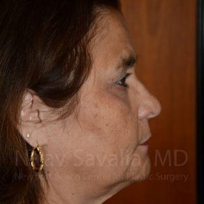 Fat Grafting to Face Before & After Gallery - Patient 1655719 - After