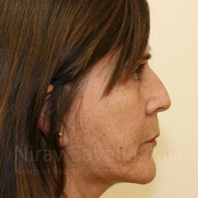 Facelift Before & After Gallery - Patient 1655721 - After