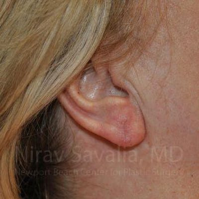 Torn Earlobe Repair Ear Gauge Repair Before & After Gallery - Patient 1655722 - After