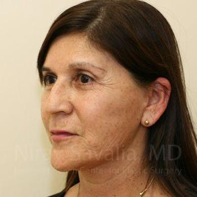 Facelift Before & After Gallery - Patient 1655721 - After