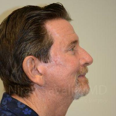 Male Breast Reduction Before & After Gallery - Patient 1655726 - After