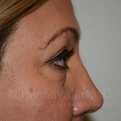 Eyelid Surgery Before & After Gallery - Patient 1655728 - After