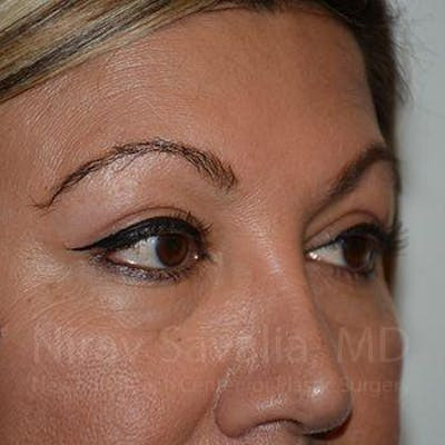 Eyelid Surgery Before & After Gallery - Patient 1655728 - After