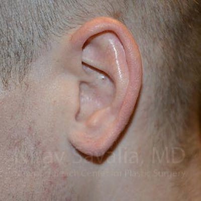 Torn Earlobe Repair Ear Gauge Repair Before & After Gallery - Patient 1655727 - After