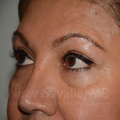 Eyelid Surgery Before & After Gallery - Patient 1655728 - After