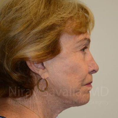 Facelift Before & After Gallery - Patient 1655786 - After