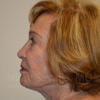 Facelift Before & After Gallery - Patient 1655786 - After