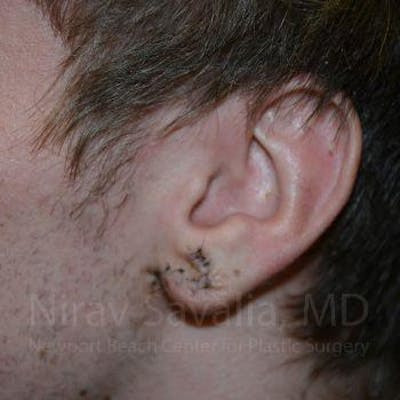 Torn Earlobe Repair Ear Gauge Repair Before & After Gallery - Patient 1655788 - After