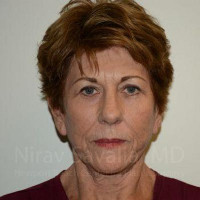 Eyelid Surgery Before & After Gallery - Patient 1655802 - Image 2