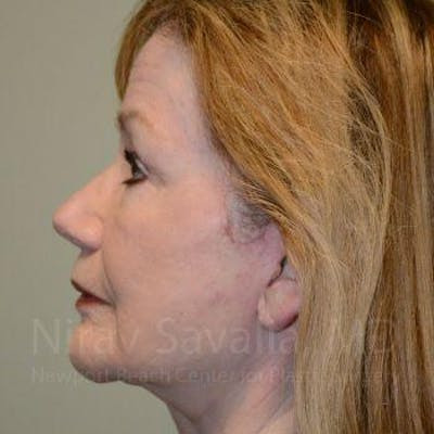 Eyelid Surgery Before & After Gallery - Patient 1655803 - After